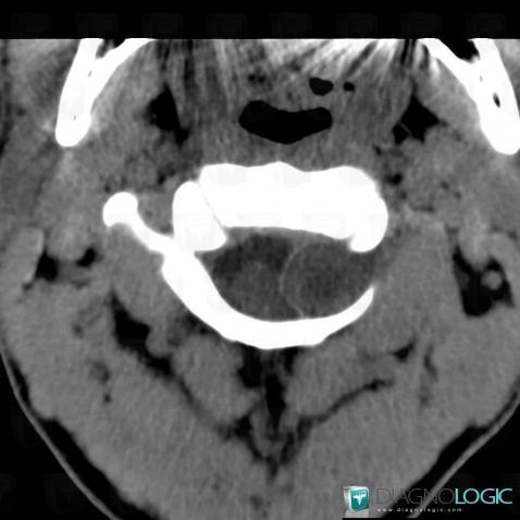 Schwannoma, Spinal canal / Cord, CT