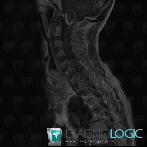 Schwannoma, Spinal canal / Cord, MRI