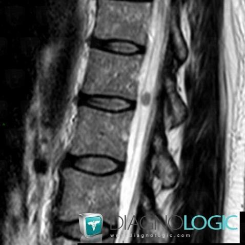 Schwannoma, Spinal canal / Cord, MRI