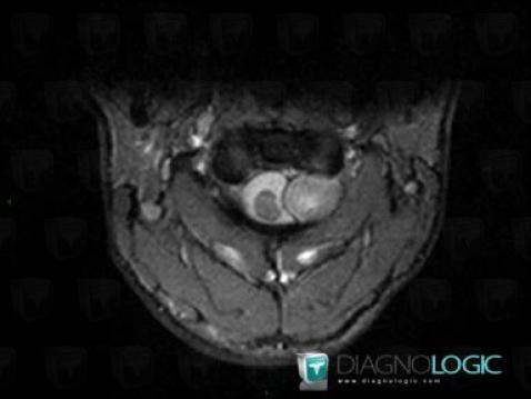 Schwannoma, Spinal canal / Cord, MRI