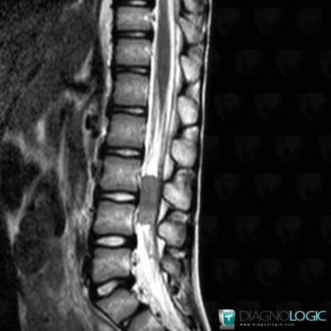 Schwannoma, Spinal canal / Cord, MRI