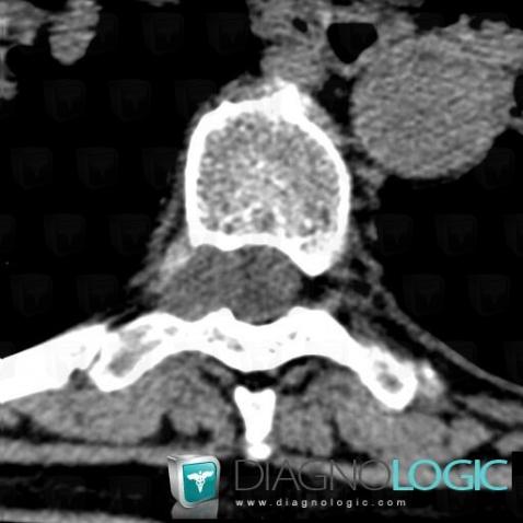 Schwannoma, Spinal canal / Cord, Paraspinal, CT