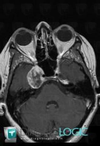 Schwannoma, Supratentorial peri cerebral spaces, Other cranial nerve, MRI