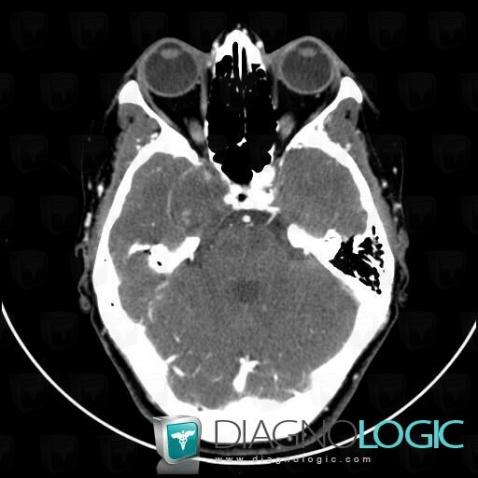 Schwannoma, Supratentorial peri cerebral spaces, Pituitary gland and parasellar region, CT