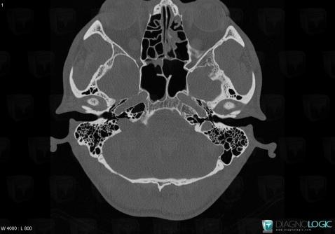 Schwannoma, Temporal bone, CT