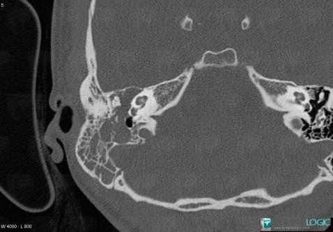 Schwannoma, VII VIII nerves, Temporal bone, CT