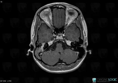 Schwannoma, VII VIII nerves, Temporal bone, MRI