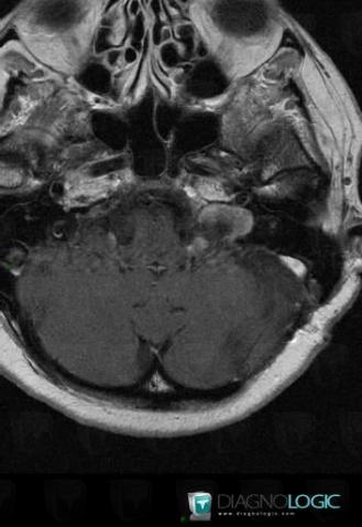 Schwannome, Foramen jugulaire, Espaces profonds de-face, IRM