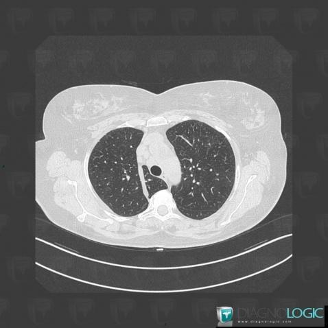 Scissure azygos, Parenchyme pulmonaire, Scanner