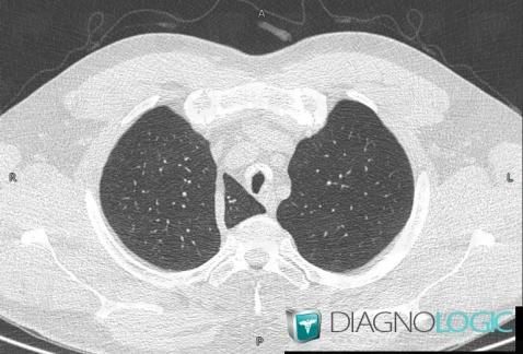 Scissure azygos, Parenchyme pulmonaire, Scanner