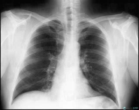 Scissure azygos, Parenchyme pulmonaire, Veines - Thorax, Radio