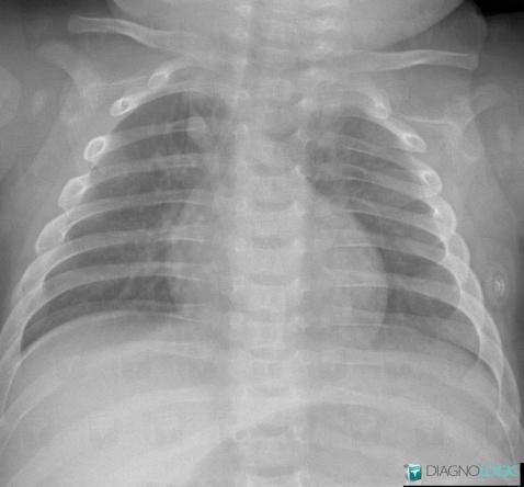 Scissure azygos, Veines - Thorax, Radio