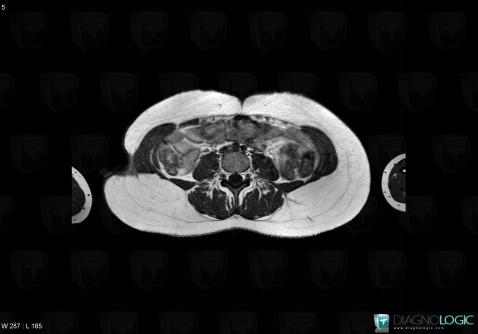 Scleroderma, Abdominal wall, Other soft tissues/nerves - Thigh, MRI