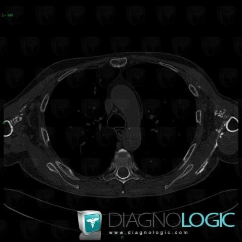 Scleroderma, Chest wall, CT