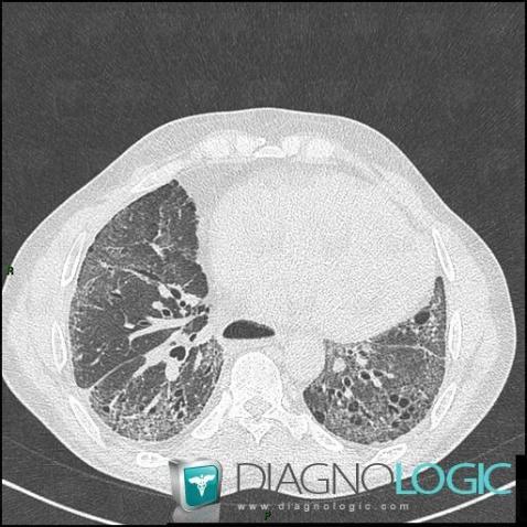 Scleroderma, Oesophagus, CT