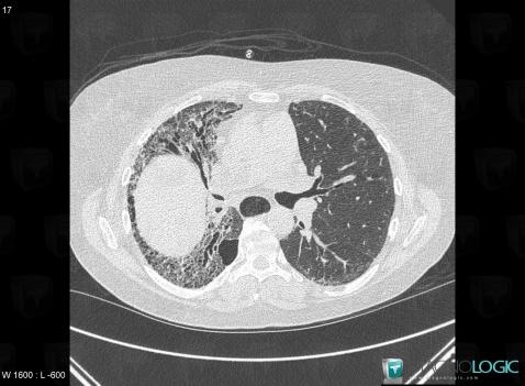 Scleroderma, Oesophagus, CT