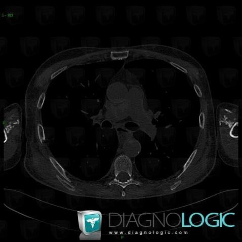 Scleroderma, Other soft tissues/nerves - Arm, CT