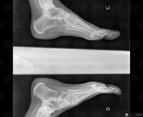 Scleroderma, Other soft tissues/nerves - Foot, X rays