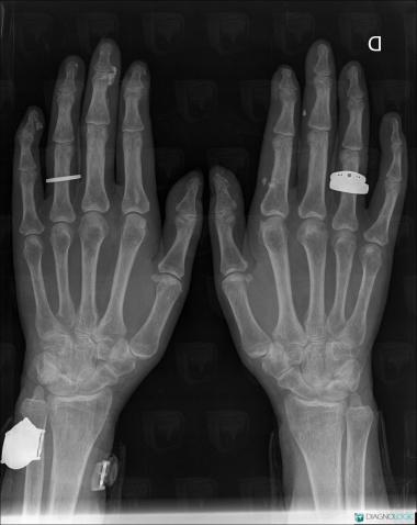 Scleroderma, Other soft tissues/nerves - Hand, X rays