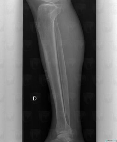 Scleroderma, Other soft tissues/nerves - Leg, X rays