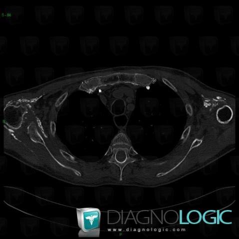 Scleroderma, Other soft tissues/nerves - Shoulder, CT