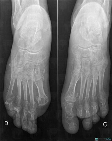 Scleroderma, Phalanx / Sesamoid bones - Foot, X rays