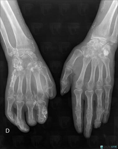 Scleroderma, Phalanx / Sesamoid bones - Hand, X rays