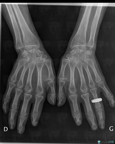Scleroderma, Phalanx / Sesamoid bones - Hand, X rays