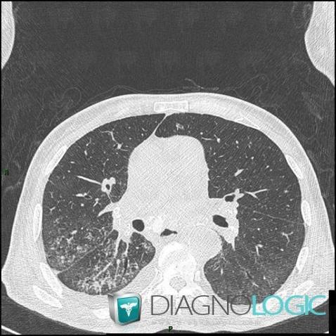 Scleroderma, Pulmonary parenchyma, CT