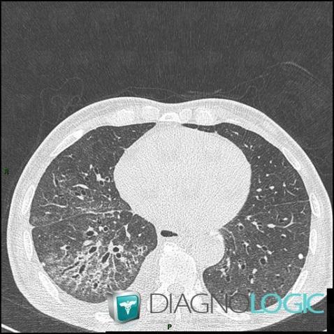 Scleroderma, Pulmonary parenchyma, CT