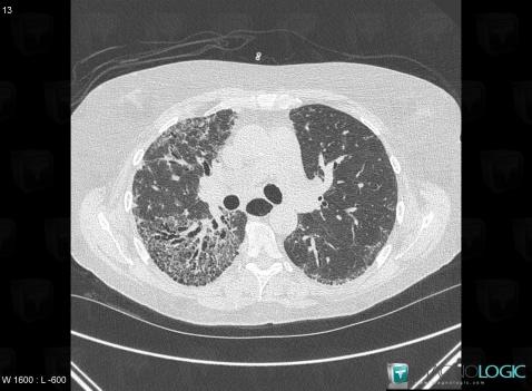 Scleroderma, Pulmonary parenchyma, CT