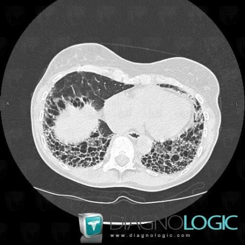 Scleroderma, Pulmonary parenchyma, CT