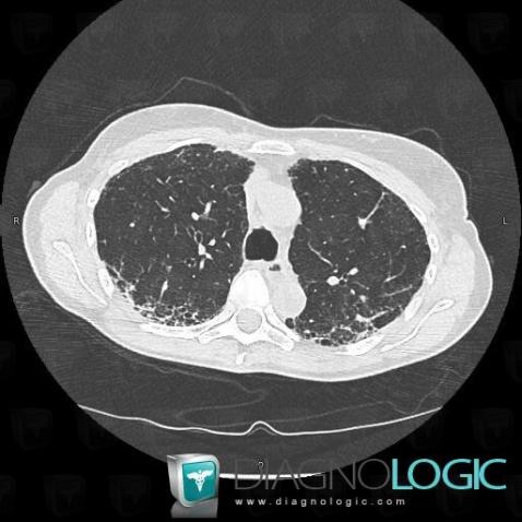 Scleroderma, Pulmonary parenchyma, CT