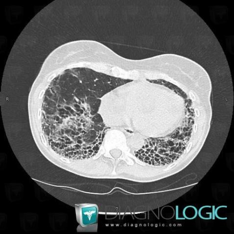 Scleroderma, Pulmonary parenchyma, CT