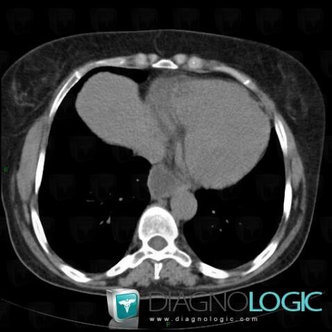 Sclérodermie, Oesophage, Scanner