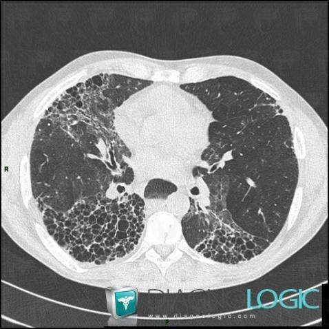 Sclérodermie, Oesophage, Scanner