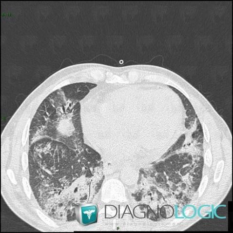 Sclérodermie, Parenchyme pulmonaire, Scanner