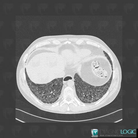 Sclérodermie, Parenchyme pulmonaire, Scanner