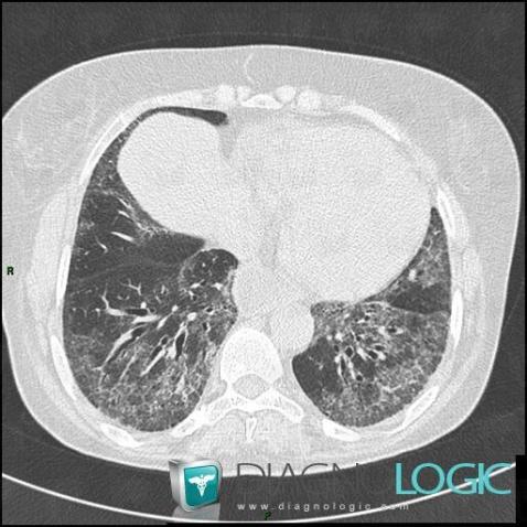 Sclérodermie, Parenchyme pulmonaire, Scanner