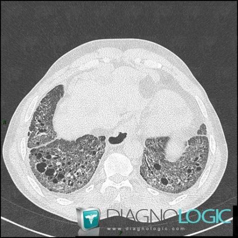 Sclérodermie, Parenchyme pulmonaire, Scanner