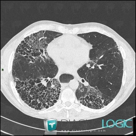 Sclérodermie, Parenchyme pulmonaire, Scanner