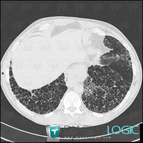 Sclérodermie, Parenchyme pulmonaire, Scanner