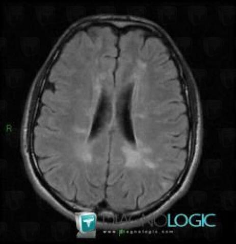 Sclérose en plaques, Ventricules / Région périventriculaire, IRM