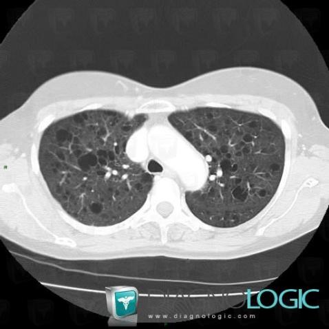 Sclérose tubéreuse-Bourneville , Parenchyme pulmonaire, Scanner