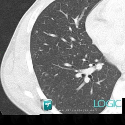 Sclérose tubéreuse-Bourneville , Parenchyme pulmonaire, Scanner