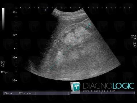 Sclérose tubéreuse-Bourneville , Rein, Echographie