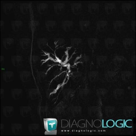 Sclerosing cholangitis, Intra and extra hepatic bile ducts, MRI