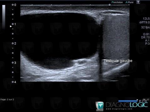 Scrotum, Echographie