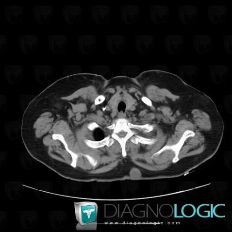 Sebaceous cyst, Chest wall, CT