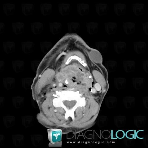 Sebaceous cyst, Soft tissues - Head and neck, CT